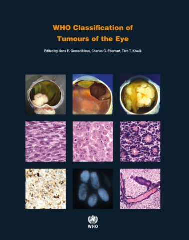 WHO Classification of Tumours of the Eye