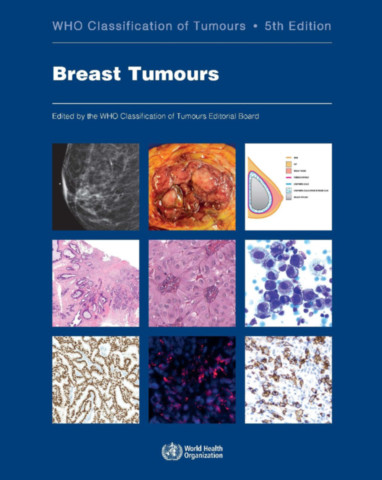 Breast Tumours